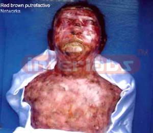 Putrefaction showing reddish discoloration